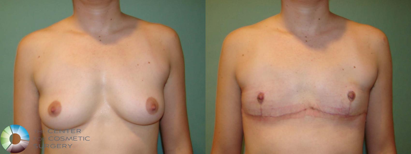 Before & After FTM Top Surgery/Chest Masculinization Case 670 Anterior in Denver and Colorado Springs, CO