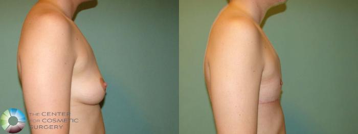 Before & After FTM Top Surgery/Chest Masculinization Case 670 Right Lateral in Denver and Colorado Springs, CO