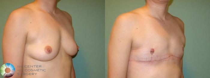 Before & After FTM Top Surgery/Chest Masculinization Case 670 Right Oblique in Denver and Colorado Springs, CO