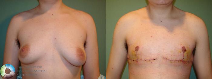 Before & After FTM Top Surgery/Chest Masculinization Case 671 Anterior in Denver and Colorado Springs, CO