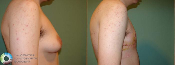 Before & After FTM Top Surgery/Chest Masculinization Case 671 Right Lateral in Denver and Colorado Springs, CO