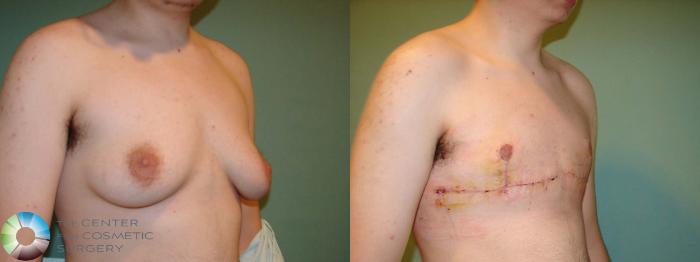 Before & After FTM Top Surgery/Chest Masculinization Case 671 Right Oblique in Denver and Colorado Springs, CO