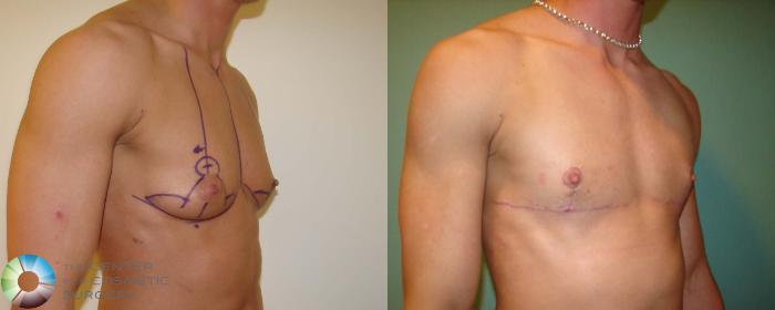 Before & After FTM Top Surgery/Chest Masculinization Case 672 View #2 in Denver, CO