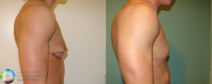 Before & After FTM Top Surgery/Chest Masculinization Case 672 View #3 in Denver, CO
