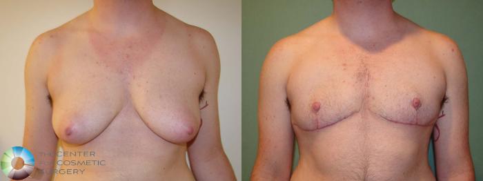 Before & After FTM Top Surgery/Chest Masculinization Case 673 Anterior in Denver and Colorado Springs, CO