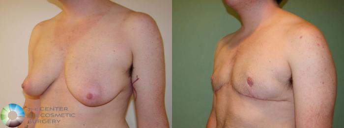 Before & After FTM Top Surgery/Chest Masculinization Case 673 Left Oblique in Denver and Colorado Springs, CO