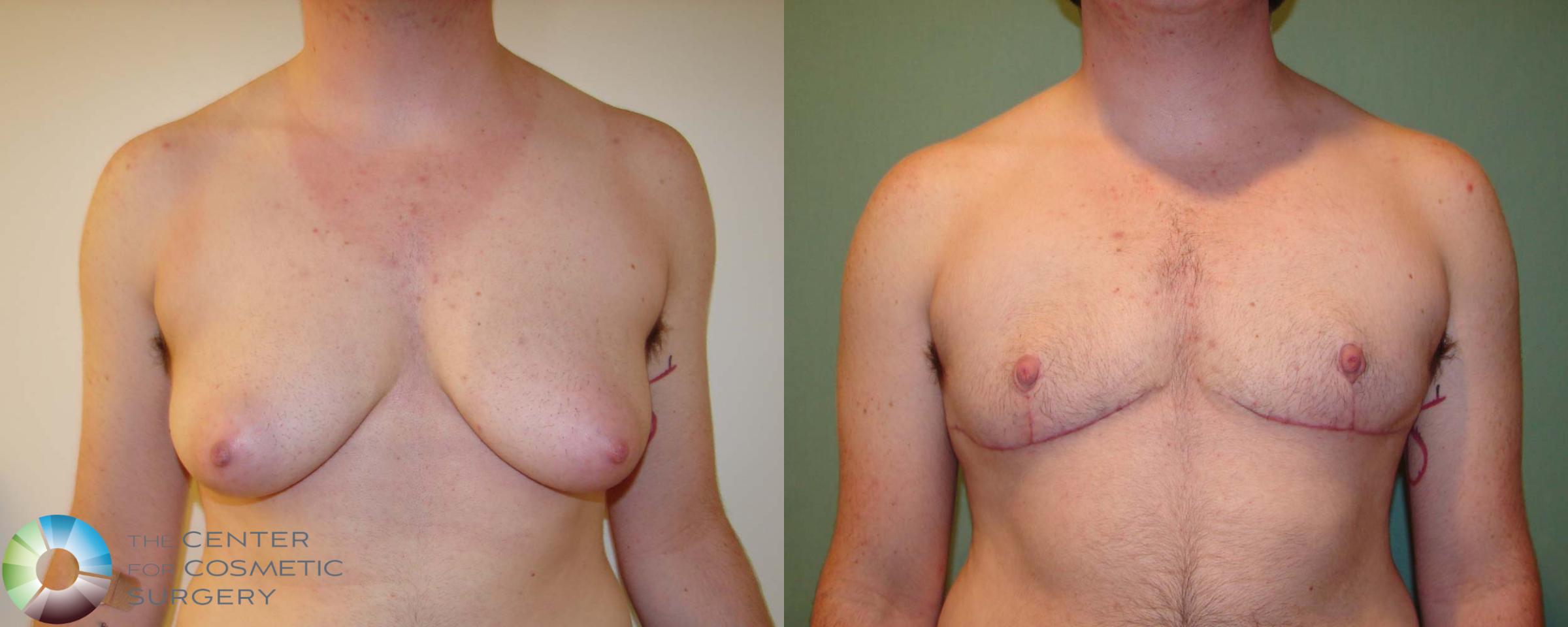 FTM Top Surgery/Chest Masculinization Case 673 Before & After View #1 | Golden, CO | The Center for Cosmetic Surgery