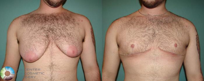 Before & After FTM Top Surgery/Chest Masculinization Case 674 View #1 in Denver, CO