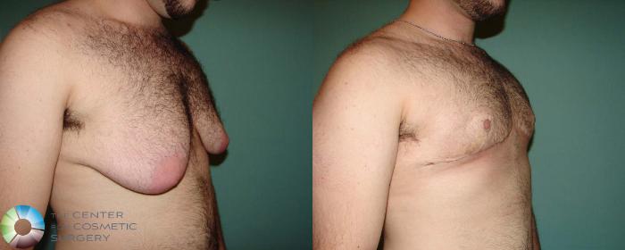 Before & After FTM Top Surgery/Chest Masculinization Case 674 View #2 in Denver, CO