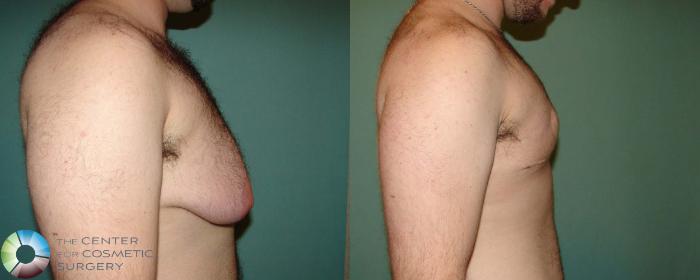 Before & After FTM Top Surgery/Chest Masculinization Case 674 View #3 in Denver, CO