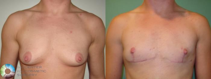 Before & After FTM Top Surgery/Chest Masculinization Case 689 Anterior in Denver and Colorado Springs, CO