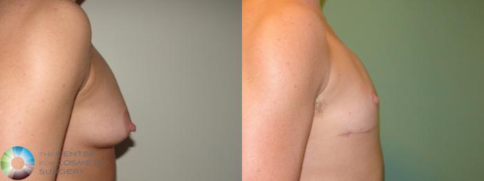 Before & After FTM Top Surgery/Chest Masculinization Case 689 Right Lateral in Denver and Colorado Springs, CO