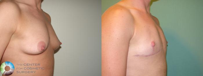 Before & After FTM Top Surgery/Chest Masculinization Case 689 Right Oblique in Denver and Colorado Springs, CO