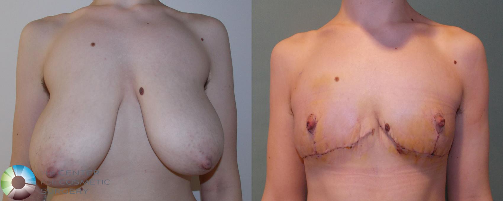 Before & After FTM Top Surgery/Chest Masculinization Case 693 View #1 in Denver and Colorado Springs, CO