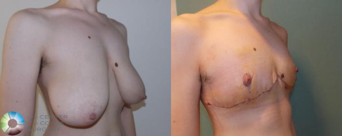 Before & After FTM Top Surgery/Chest Masculinization Case 693 View #2 in Denver and Colorado Springs, CO