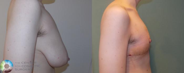 Before & After FTM Top Surgery/Chest Masculinization Case 693 View #3 in Denver and Colorado Springs, CO