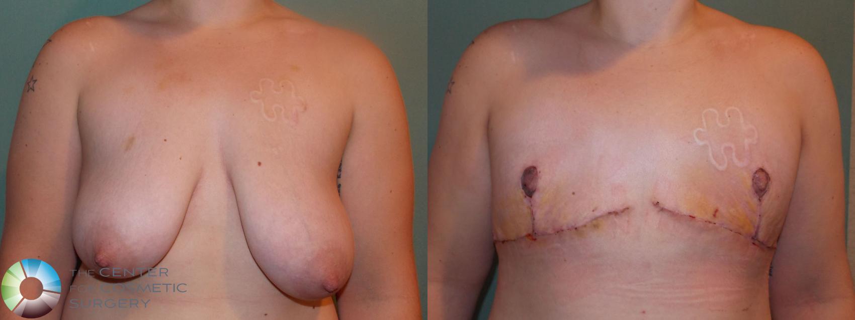 Before & After FTM Top Surgery/Chest Masculinization Case 697 Anterior in Denver and Colorado Springs, CO