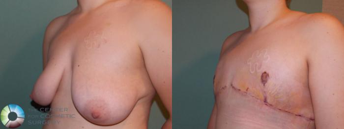 Before & After FTM Top Surgery/Chest Masculinization Case 697 Left Oblique in Denver and Colorado Springs, CO