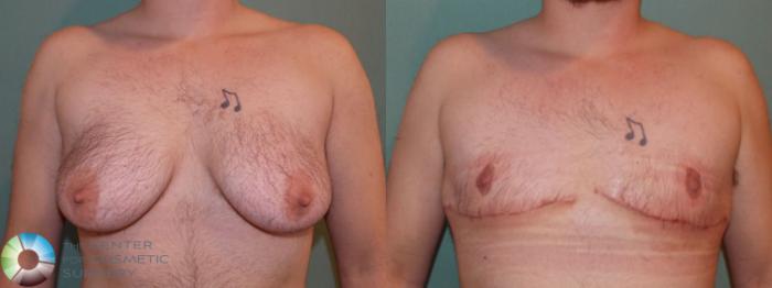 Before & After FTM Top Surgery/Chest Masculinization Case 698 Anterior in Denver and Colorado Springs, CO