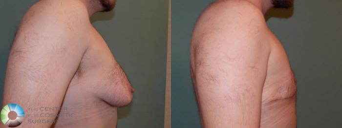 Before & After FTM Top Surgery/Chest Masculinization Case 698 Right Lateral in Denver and Colorado Springs, CO