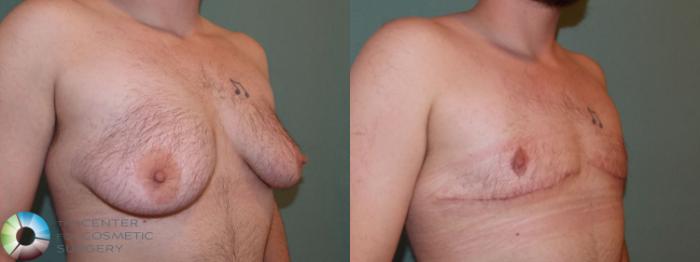 Before & After FTM Top Surgery/Chest Masculinization Case 698 Right Oblique in Denver and Colorado Springs, CO
