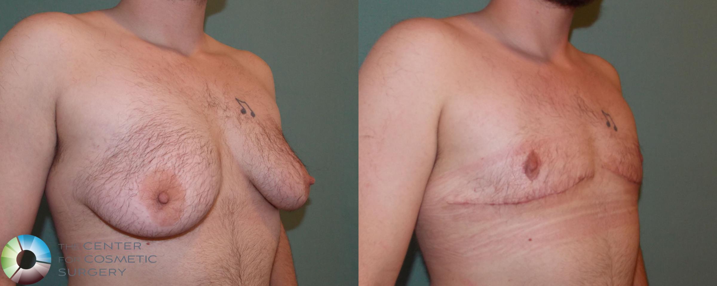 FTM Top Surgery/Chest Masculinization Case 698 Before & After View #1 | Golden, CO | The Center for Cosmetic Surgery