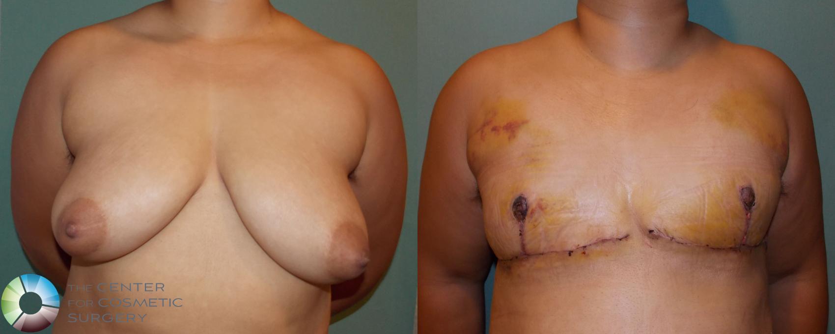 Before & After FTM Top Surgery/Chest Masculinization Case 699 View #1 in Denver and Colorado Springs, CO