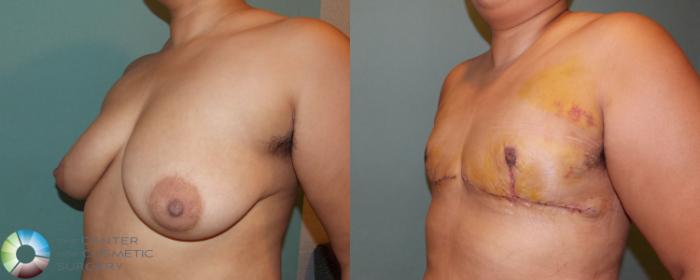 Before & After FTM Top Surgery/Chest Masculinization Case 699 View #2 in Denver and Colorado Springs, CO