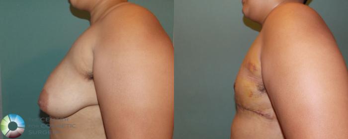 Before & After FTM Top Surgery/Chest Masculinization Case 699 View #3 in Denver and Colorado Springs, CO