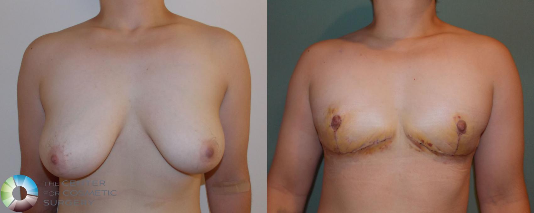 Before & After FTM Top Surgery/Chest Masculinization Case 700 View #1 in Denver and Colorado Springs, CO