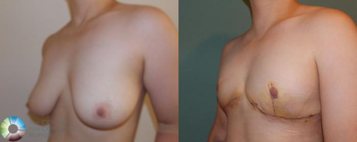 Before & After FTM Top Surgery/Chest Masculinization Case 700 View #2 in Denver and Colorado Springs, CO