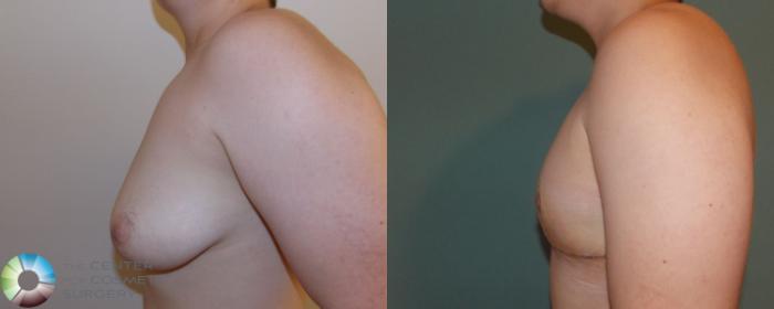Before & After FTM Top Surgery/Chest Masculinization Case 700 View #3 in Denver and Colorado Springs, CO
