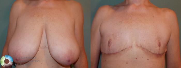 Before & After FTM Top Surgery/Chest Masculinization Case 701 Anterior in Denver and Colorado Springs, CO