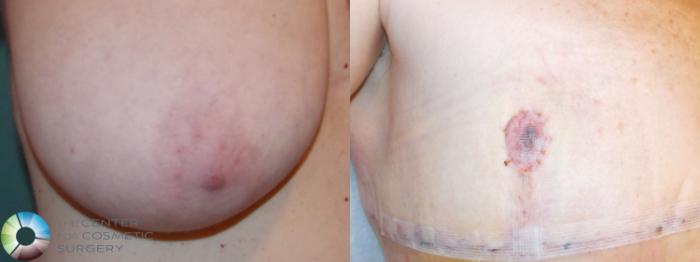 Before & After FTM Top Surgery/Chest Masculinization Case 701 Nipple-graft Close-up in Denver and Colorado Springs, CO