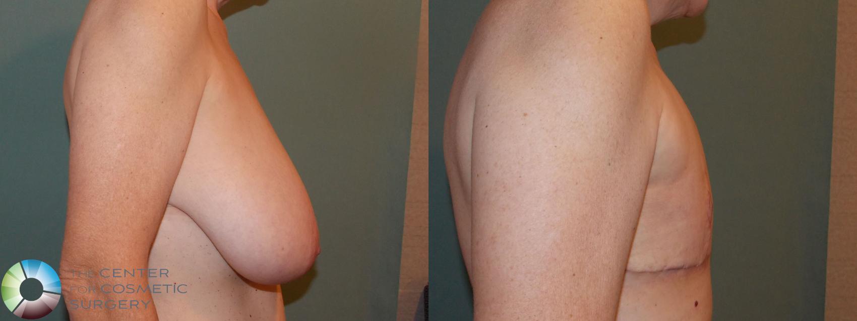 Before & After FTM Top Surgery/Chest Masculinization Case 701 Right Lateral in Denver and Colorado Springs, CO