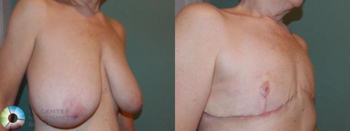 Before & After FTM Top Surgery/Chest Masculinization Case 701 Right Oblique in Denver and Colorado Springs, CO