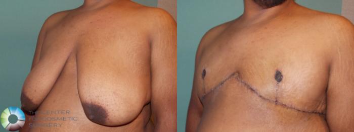 Before & After FTM Top Surgery/Chest Masculinization Case 702 Left Oblique in Denver, CO