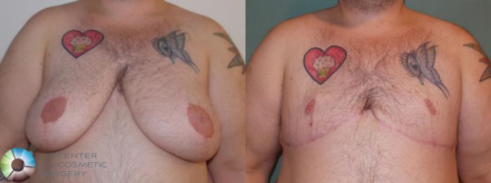 Before & After FTM Top Surgery/Chest Masculinization Case 703 Anterior in Denver and Colorado Springs, CO