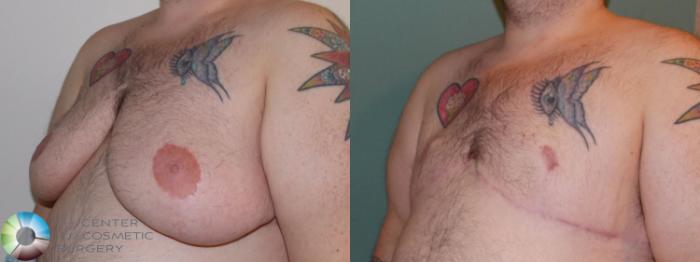 Before & After FTM Top Surgery/Chest Masculinization Case 703 Left Oblique in Denver and Colorado Springs, CO