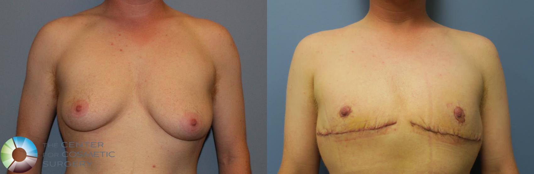 Before & After FTM Top Surgery/Chest Masculinization Case 766 Anterior in Denver and Colorado Springs, CO