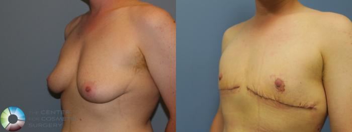 Before & After FTM Top Surgery/Chest Masculinization Case 766 Left Oblique in Denver and Colorado Springs, CO