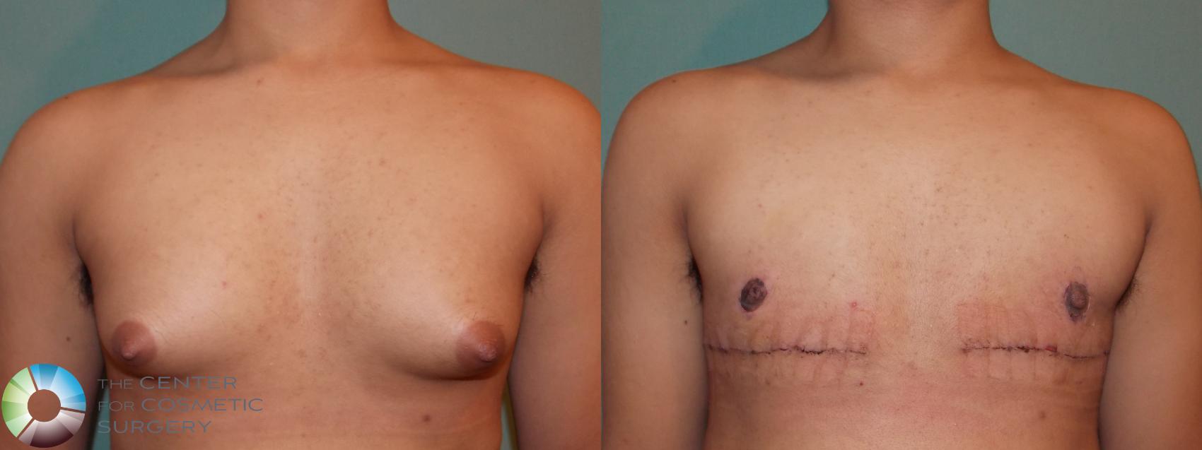Before & After FTM Top Surgery/Chest Masculinization Case 767 Anterior in Denver and Colorado Springs, CO