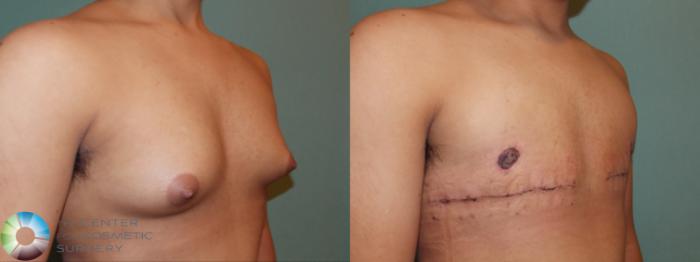 Before & After FTM Top Surgery/Chest Masculinization Case 767 Right Oblique in Denver and Colorado Springs, CO