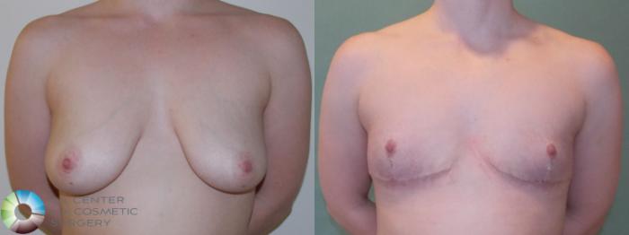 Before & After FTM Top Surgery/Chest Masculinization Case 768 Anterior in Denver and Colorado Springs, CO