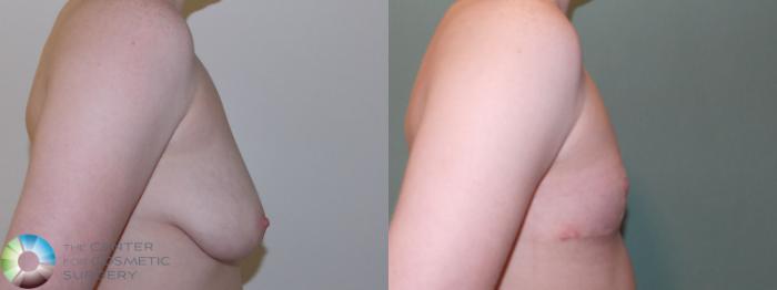 Before & After FTM Top Surgery/Chest Masculinization Case 768 Right Lateral in Denver and Colorado Springs, CO