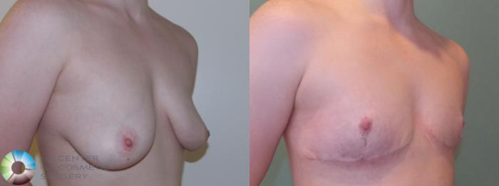 Before & After FTM Top Surgery/Chest Masculinization Case 768 Right Oblique in Denver and Colorado Springs, CO