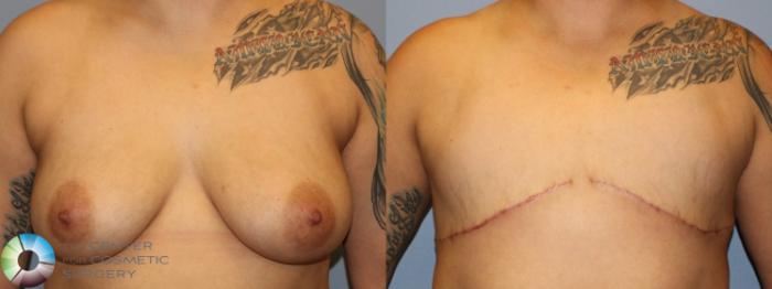 Before & After FTM Top Surgery/Chest Masculinization Case 855 Anterior in Denver and Colorado Springs, CO