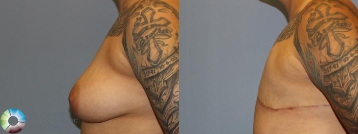 Before & After FTM Top Surgery/Chest Masculinization Case 855 Left Lateral in Denver and Colorado Springs, CO