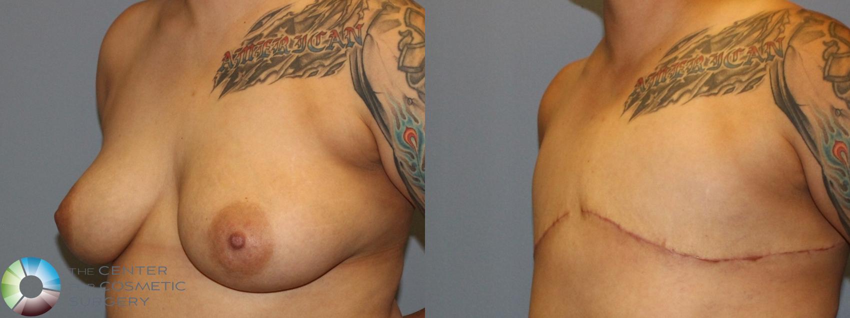 Before & After FTM Top Surgery/Chest Masculinization Case 855 Left Oblique in Denver and Colorado Springs, CO