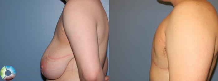 Before & After FTM Top Surgery/Chest Masculinization Case 856 Left Lateral in Denver, CO
